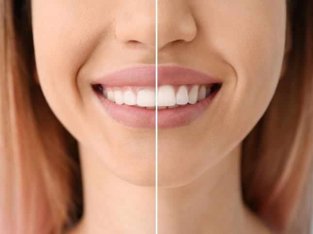 Close up of smile before and after correcting a gummy smile