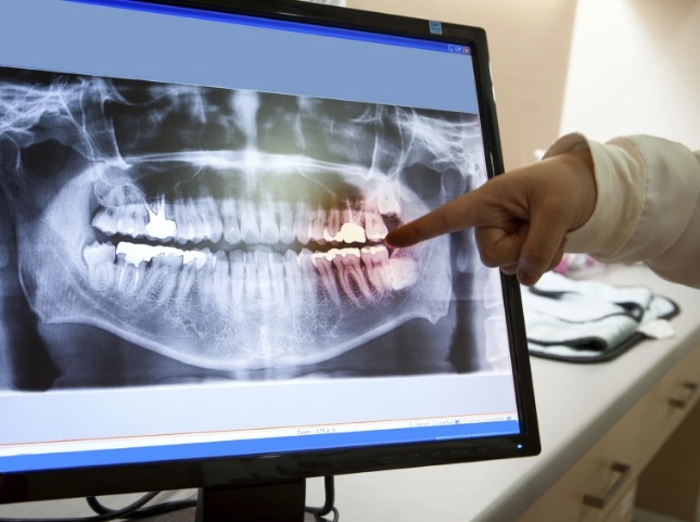 Dentist pointing to computer with x rays of teeth