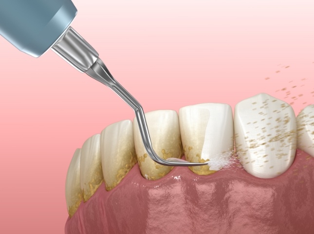 Illustrated dental instruments clearing plaque buildup from teeth