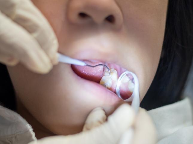 Close up of pediatric dentist giving a child a dental exam