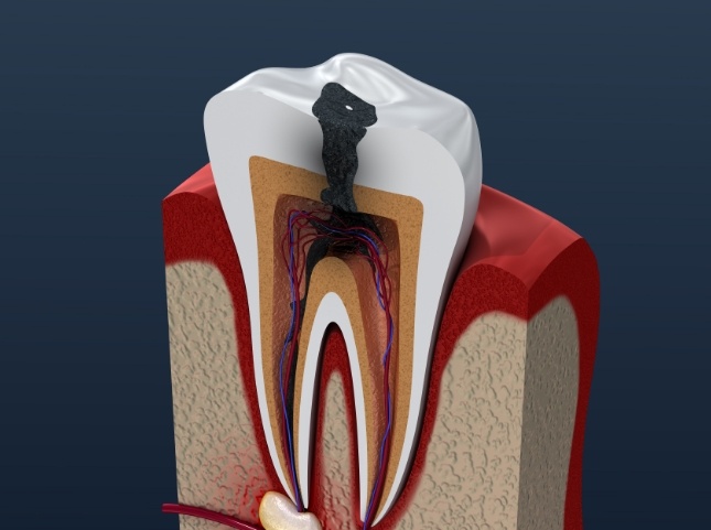 Illustrated decayed tooth