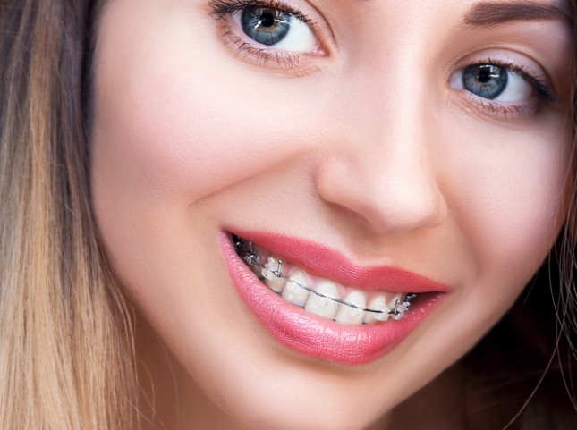 Close up of teenage girl smiling with clear ceramic braces