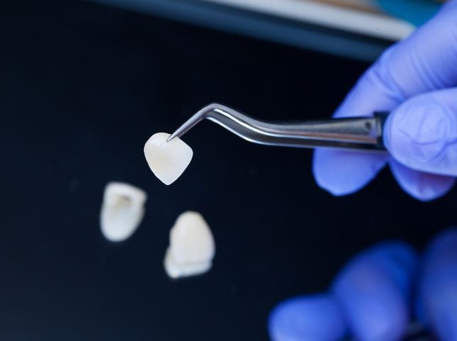 Gloved hand holding a dental veneer with tweezers