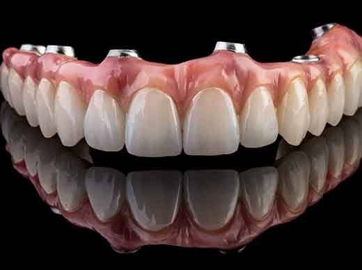 Upper arch of implant dentures on a black reflective surface