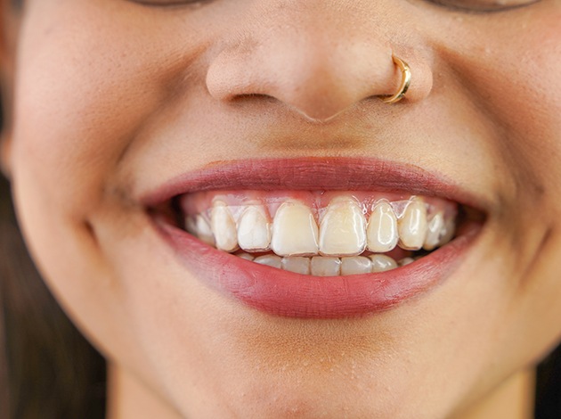Closeup of woman’s teeth with clear aligners on them