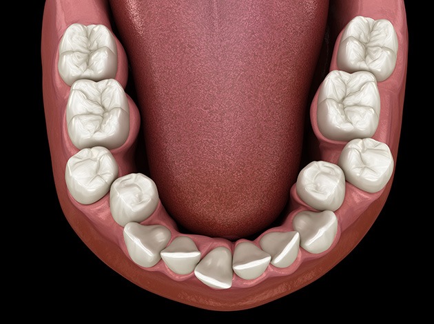 Illustration of a crowded teeth