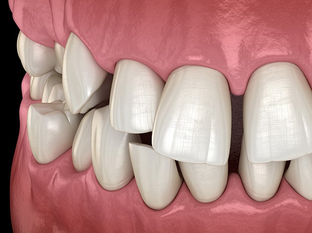 Illustration of gapped teeth