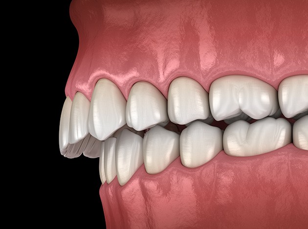 Illustration of an overbite