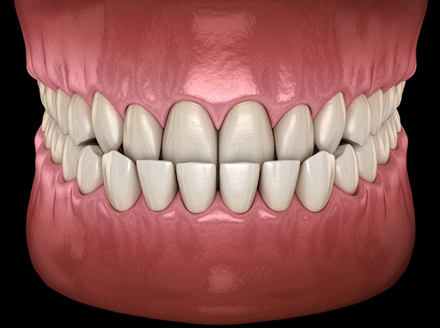 Illustration of an underbite