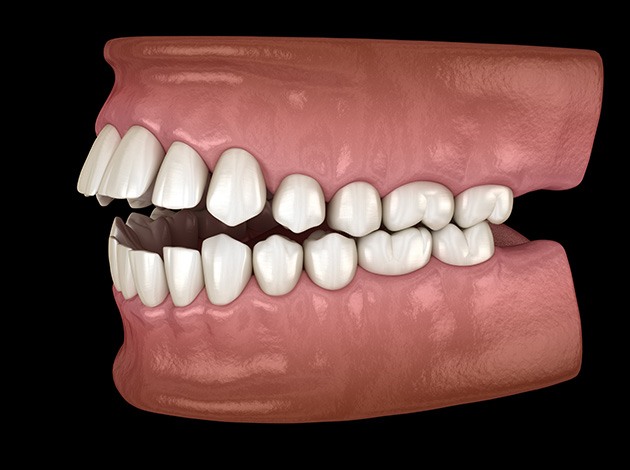 Illustration of an open bite