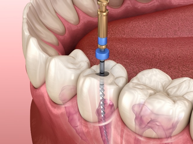 Illustrated dental instrument cleaning inside of tooth during root canal treatment