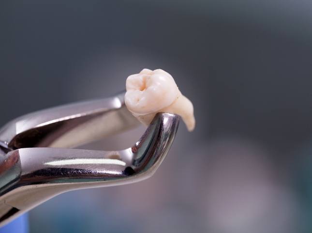 Dental forceps holding an extracted tooth