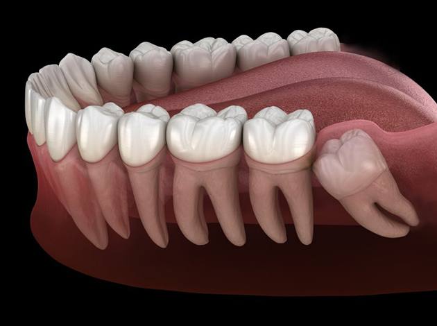 Illustration of impacted wisdom teeth in gum tissue
