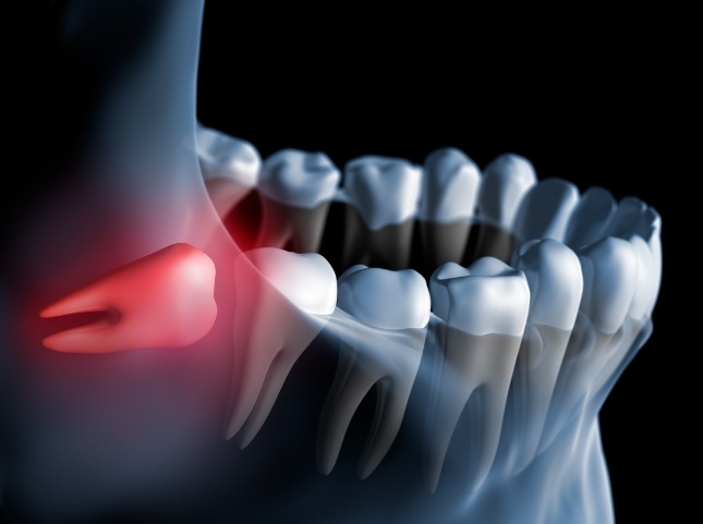 Illustrated impacted wisdom tooth pressing against back molar