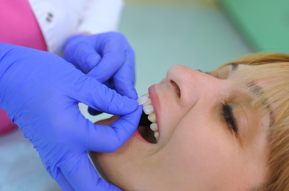 Patient being fitted for veneers